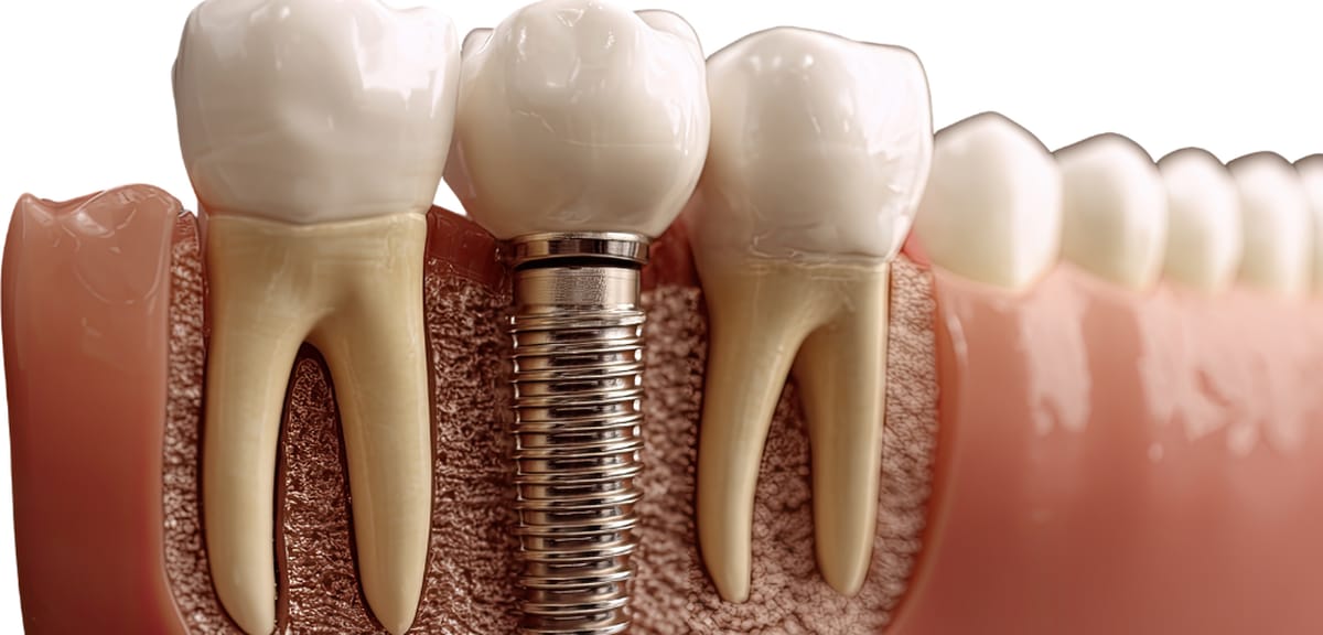 implant dentar