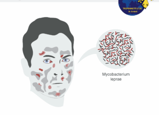 lepra confirmata in romania